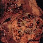 Carcinoma